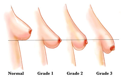 breast lift surgery abroad